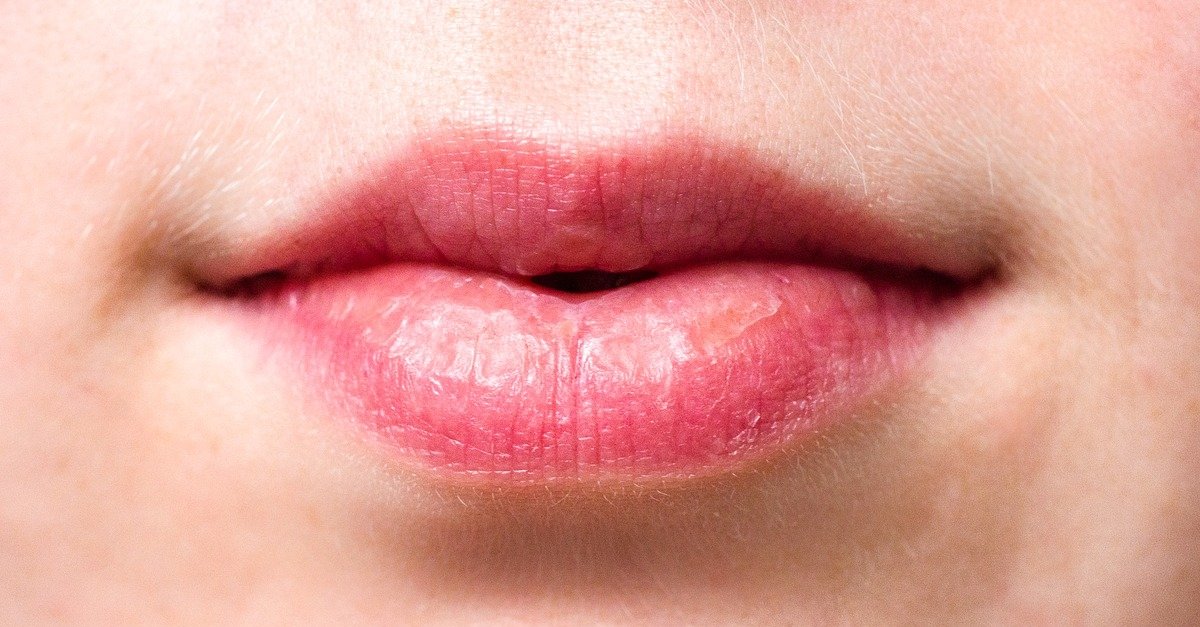 droge lippen